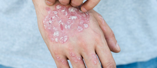 psoriasis